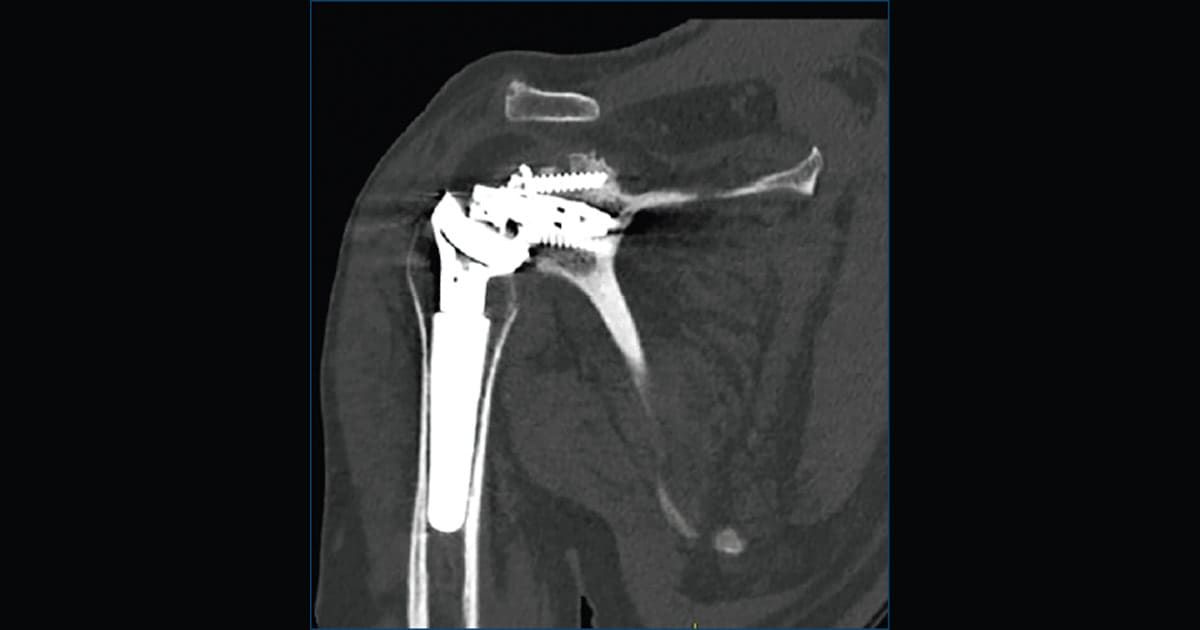 Complicanze nella protesi totale di spalla inversa: Analisi di un caso clinico e considerazioni per la pratica Ortopedica