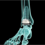 Protesi di Caviglia
